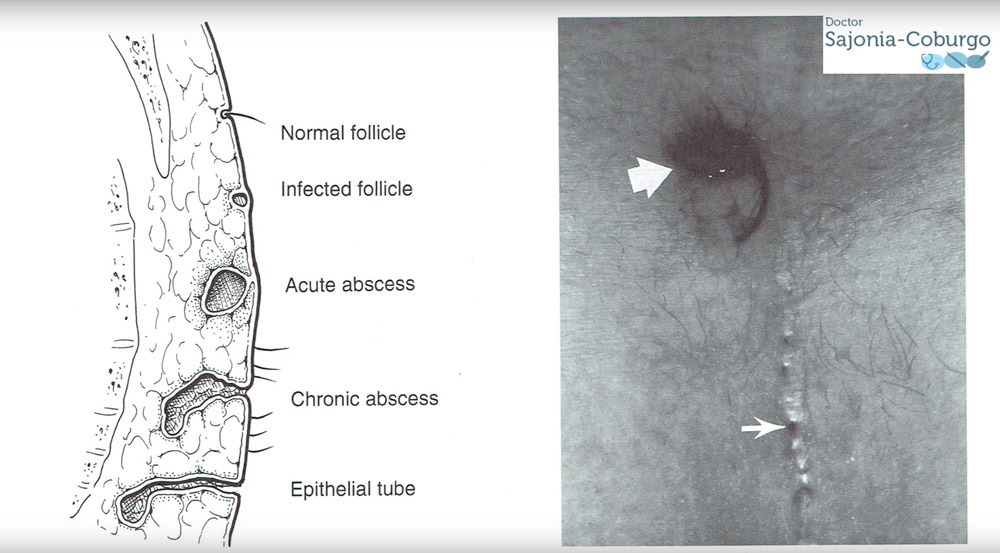 distintas fases de un sinus pilonidal