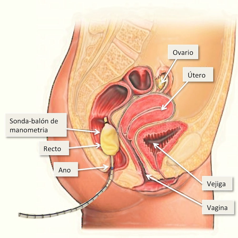 Dibujo explicando una manometría Anal